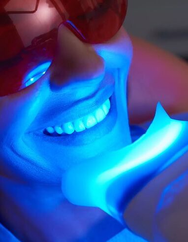 blanchiment dentaire