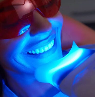 blanchiment dentaire